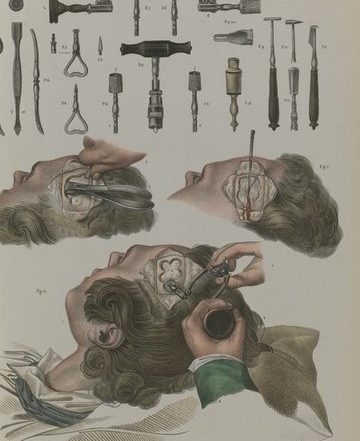 Processo cirurgico antes da anestesia moderna